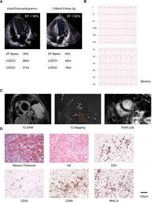 Case Report: Sudden very late-onset near fatal PD1 inhibitor-associated myocarditis with out-of-hospital cardiac arrest after >2.5 years of pembrolizumab treatment